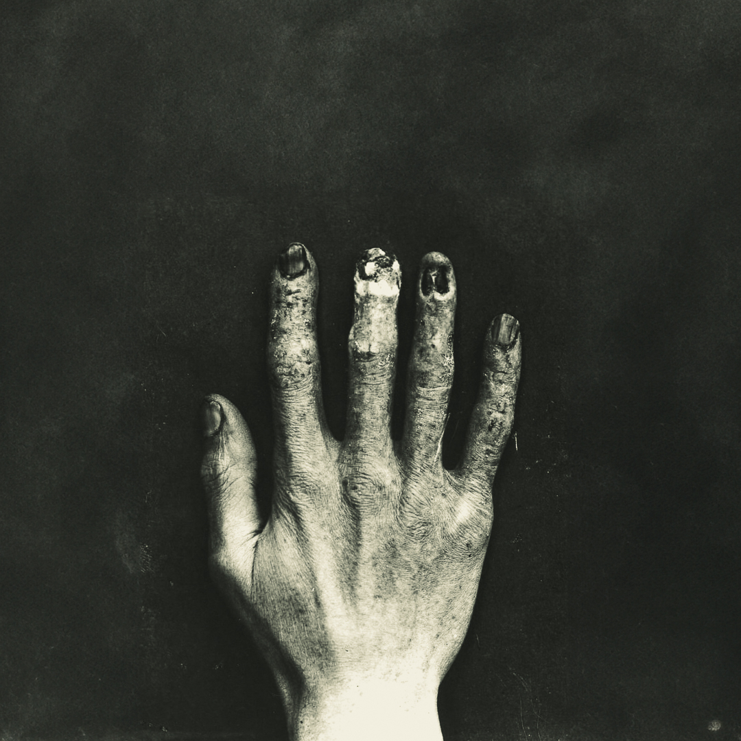 Dr. Eugene Corson initiated his X-ray machine with a unique ritual. With his hand, he awaited the telltale red glow from the radiation, an act that left him with stubs on both arms. Having passed in 1946, many believe the handless man still lingers in his former Savannah home.