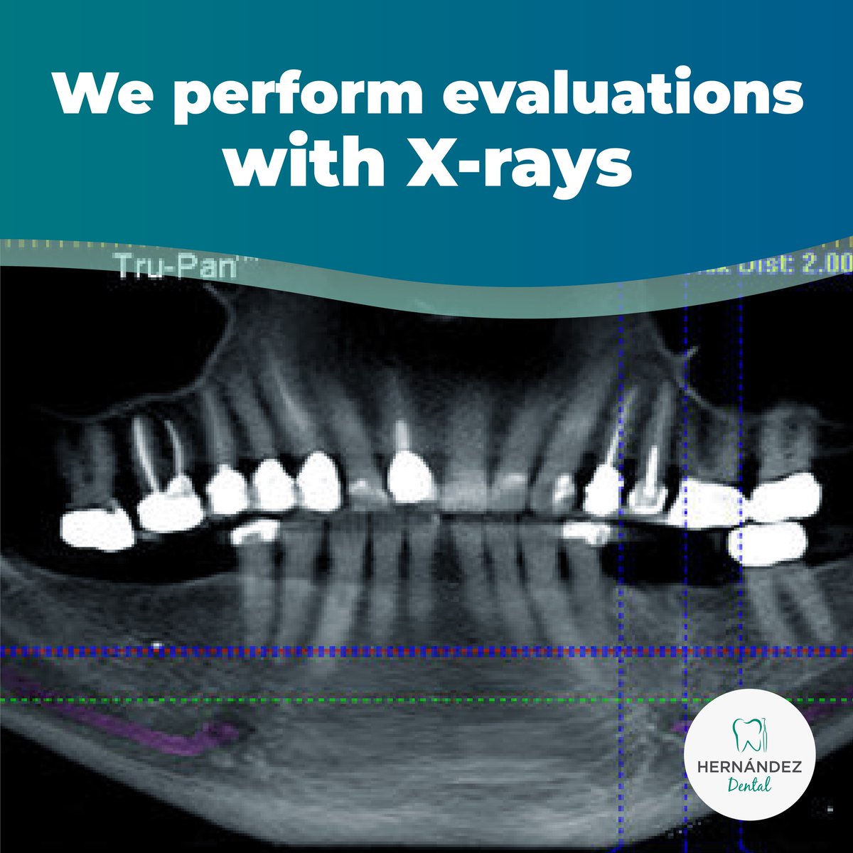 #dentalimplants #dentalrehabilitation #dentalaesthetics #dentist #bestdentist #dentalhealth #dentalcare #dentistry #dentalclinic #dental #dentistrylife #losalgodones #yuma #somerton #lasvegas #utah #phoenix #losangeles #tucson