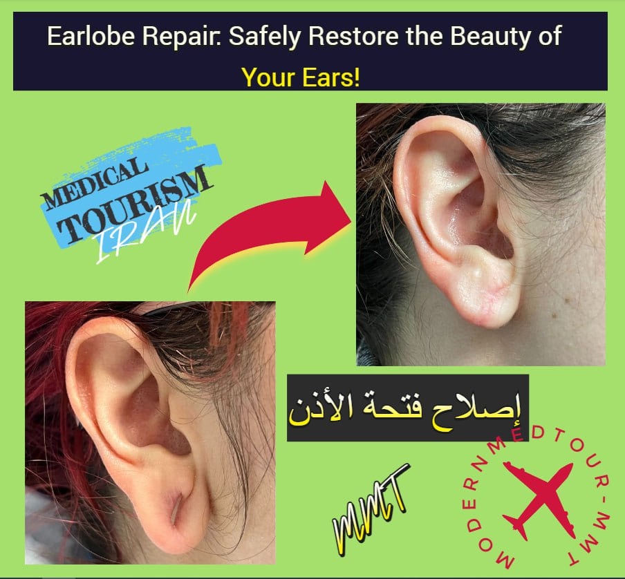 IranModernmed's tweet photo. إصلاح فتحة الأذن: استعيد جمال أذنيك بأمان! 👂🔧
تواصل معنا للحصول على استشارة ومزيد من المعلومات.
📱 WhatsApp: +989353143361
🌐 الموقع الإلكتروني: https://t.co/YHxqsVrLeQ
#EarlobeRepair #إصلاح_فتحة_الأذن #جراحة_الأذن #ModernMedTour #تجميل_الأذن https://t.co/xBGxsG4Bc8