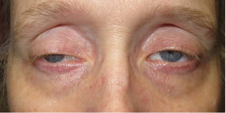 patient with weakness, double vision &amp; breathlessness mostly at the end of the day.

Diagnosis?