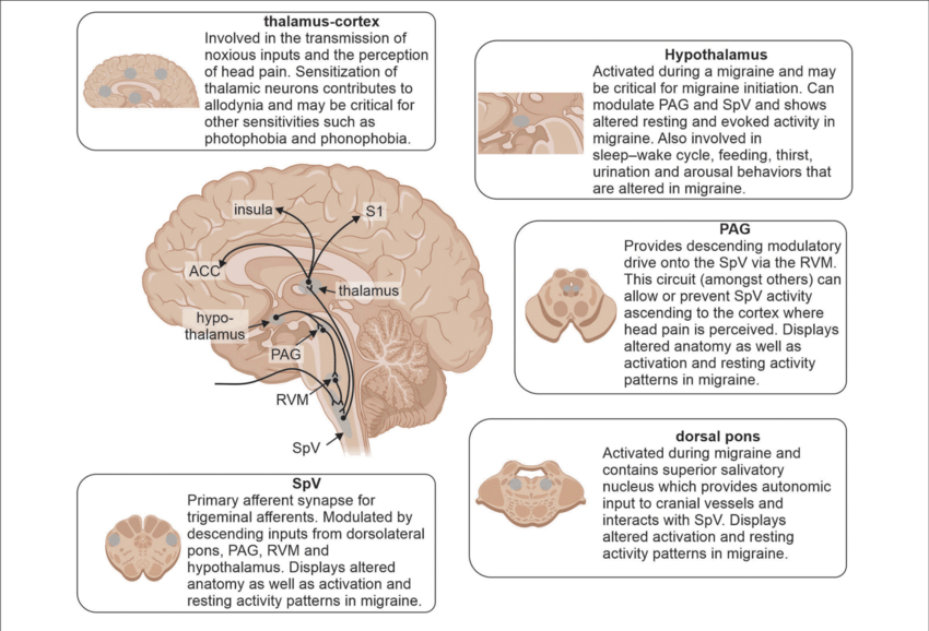 Brain regions involved in underlying mechanisms of migraine and reported alterations. Any comments? Credits: Tiffani J. Mungoven, Luke A Henderson & Noemi Meylakh #MedTwitter