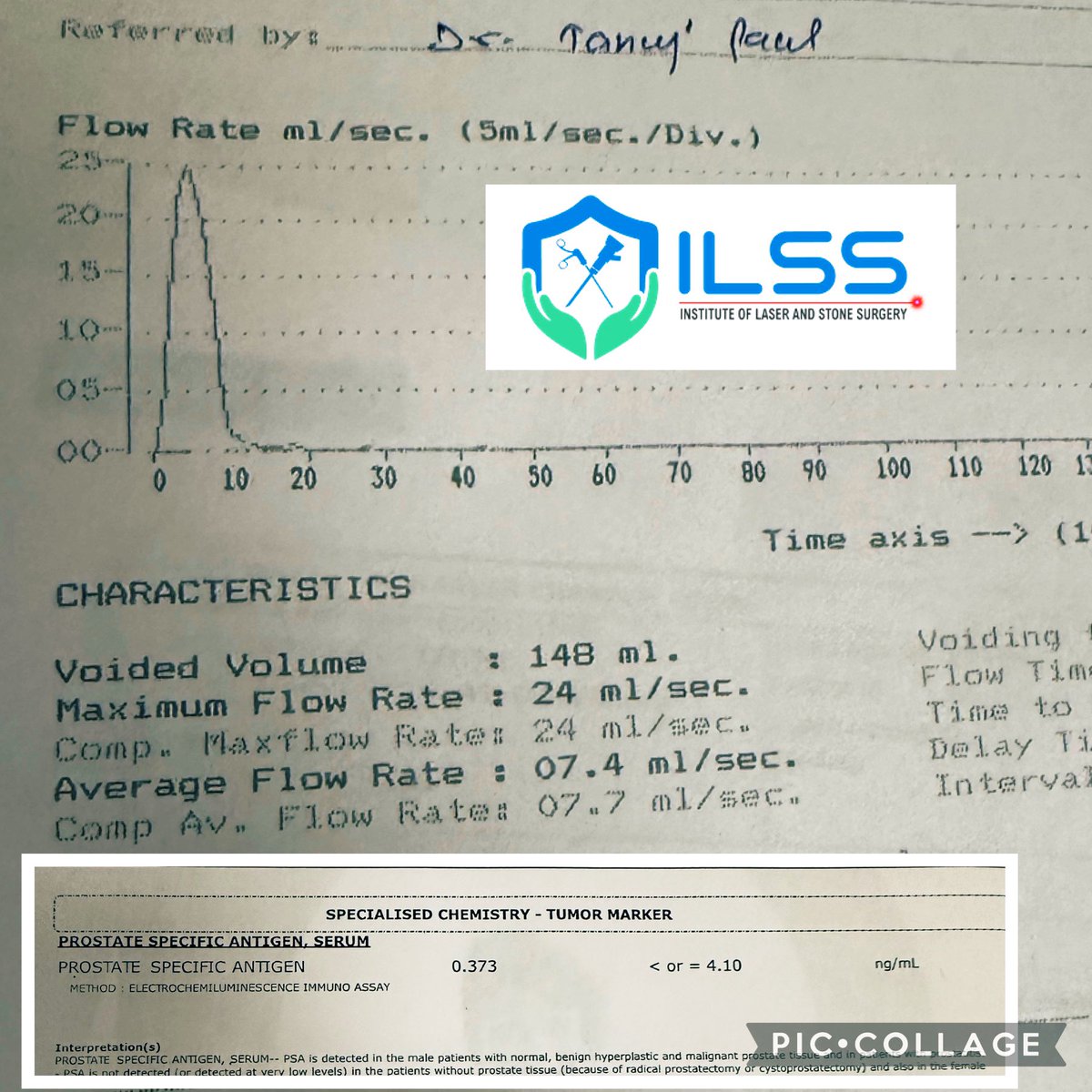 RIRS_inDelhiNCR's tweet photo. Reassuring Postoperative results of EPS #HoLEP, excellent #uroflow , marked decrease in #PSA #LASERhospital #ILSShospital #lasersurgery #prostate https://t.co/G2ItBQfasZ