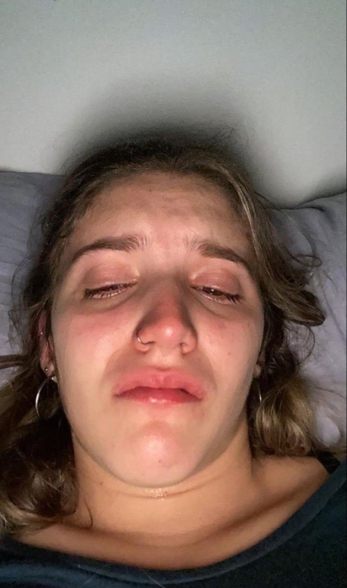 se me rompió una uña