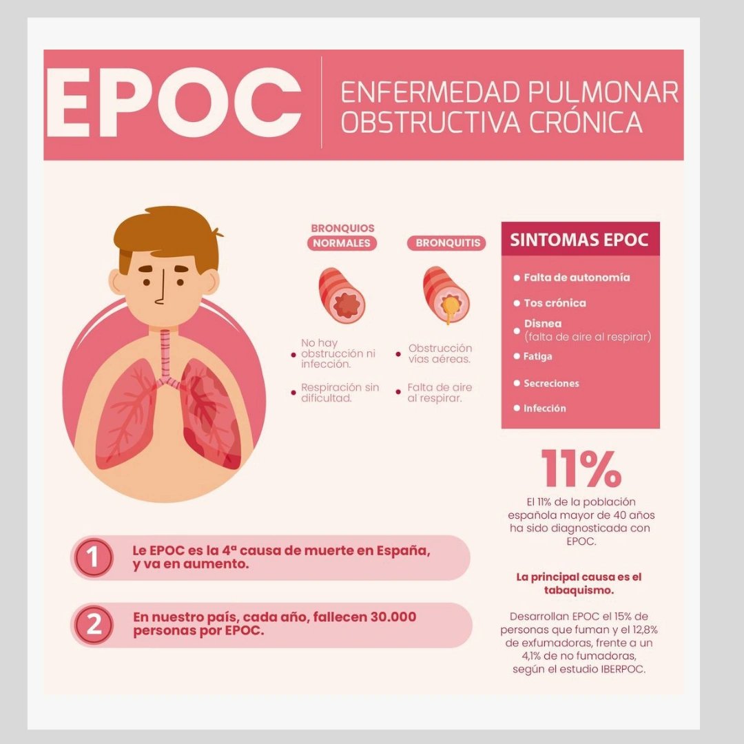 Formacion Sanitaria (@formsanitaria) on Twitter photo La #enfermedadpulmonar obstructiva crónica (#EPOC) es una #afecciónpulmonar crónica que dificulta la respiración. Se caracteriza por la obstrucción del flujo de aire y suele estar relacionada con el tabaquismo.
.
Infografía <a href="/cfisiomad/">CP Fisioterapeutas Madrid | #somosloquenecesitas</a>
.
#formacionsanitaria #sanidad #cursosonline La #enfermedadpulmonar obstructiva crónica (#EPOC) es una #afecciónpulmonar crónica que dificulta la respiración. Se caracteriza por la obstrucción del flujo de aire y suele estar relacionada con el tabaquismo.
.
Infografía <a href="/cfisiomad/">CP Fisioterapeutas Madrid | #somosloquenecesitas</a>
.
#formacionsanitaria #sanidad #cursosonline