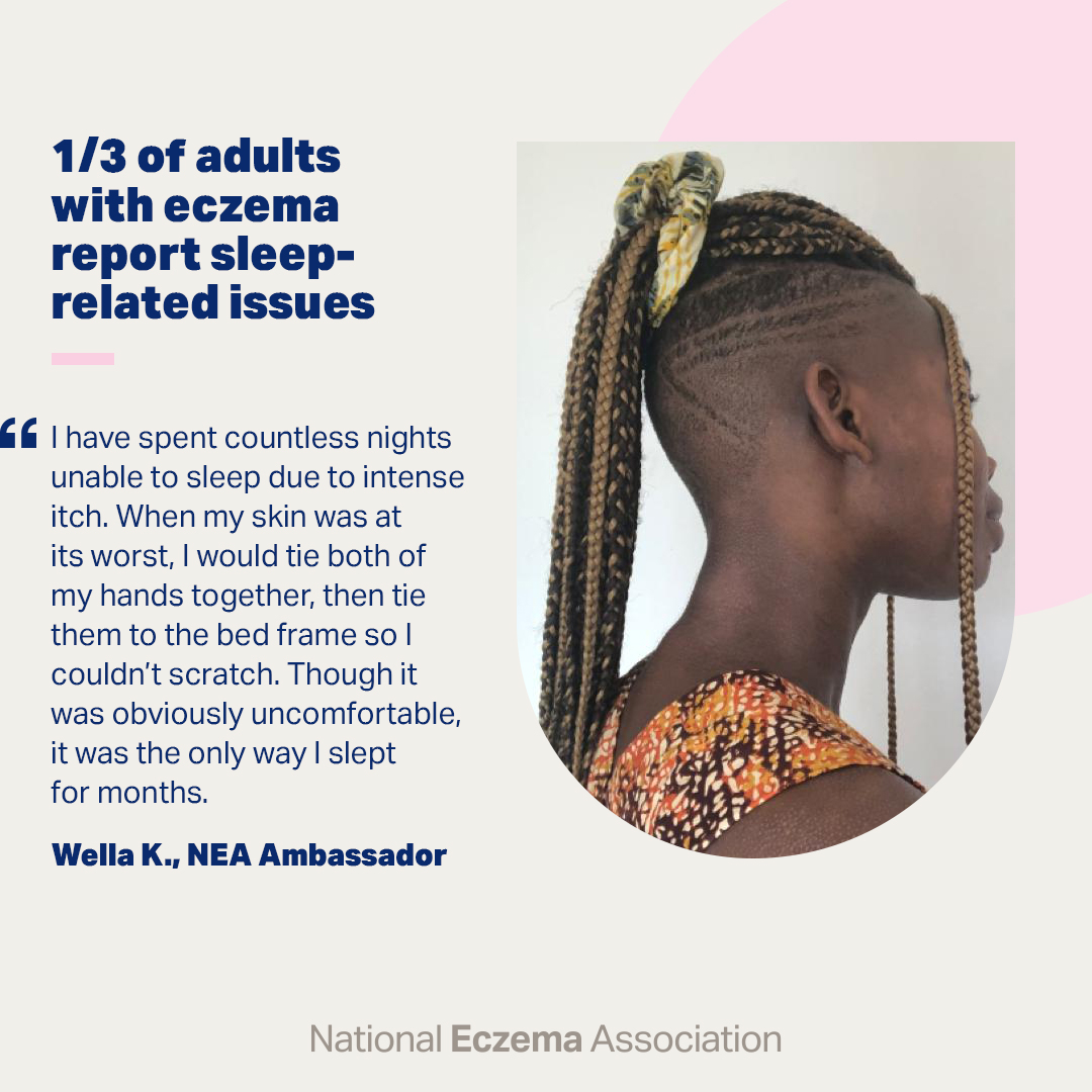 nationaleczema's tweet photo. Wella's eczema was so itchy, she resorted to tying her hands to her bedframe at night for better sleep.
Join Wella and become a #NEAAmbassador today: https://t.co/9mUMYjRsjS
#unhideECZEMA #NEAAmbassadors #eczemacommunity https://t.co/PcLCBrY9PP