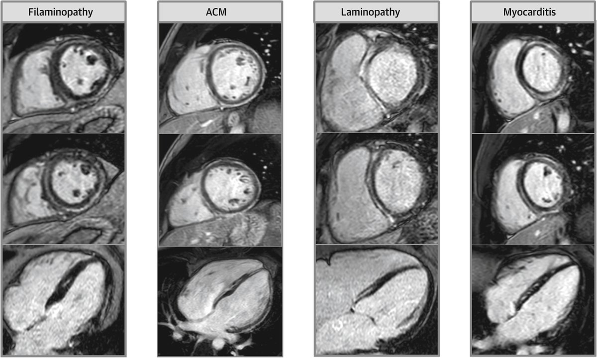 A ring of destiny on #WhyCMR – not to be ignored? In this #JACCIMG iMail, patients with a ring-like late gadolinium enhancement pattern were associated with a “genetic” cardiomyopathy and ventricular arrhythmias. bit.ly/3Pl5tA6