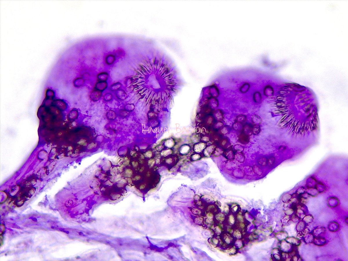Spectacular scolex photomicrograph. Echinococcus granulosus. #hydatidosis #pathology #photomicrograph #scolex
