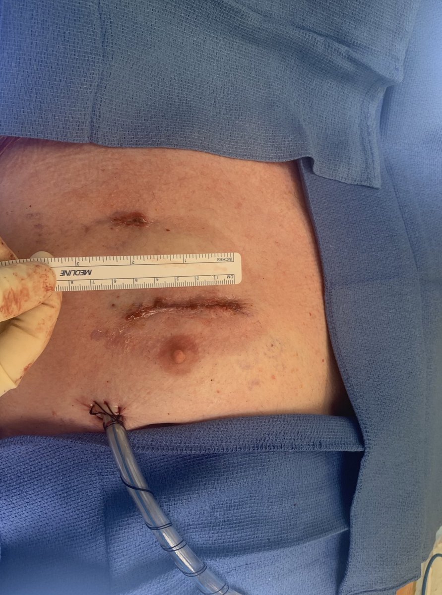 Robotic #lungtansplant can be done through an incision about 2 inches in size! Currently, the only group doing this is <a href="/CedarsSinai/">Cedars-Sinai</a>. #transplant <a href="/ActionPFcharity/">Action for Pulmonary Fibrosis</a>