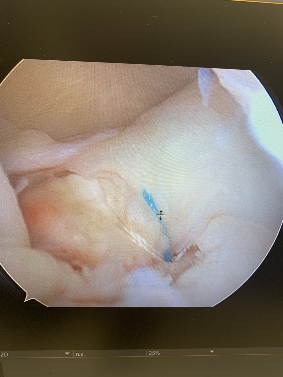 13 year old with isolated medial meniscus root avulsion. Snowboarding noncontact injury. Ugh. #orthotwitter