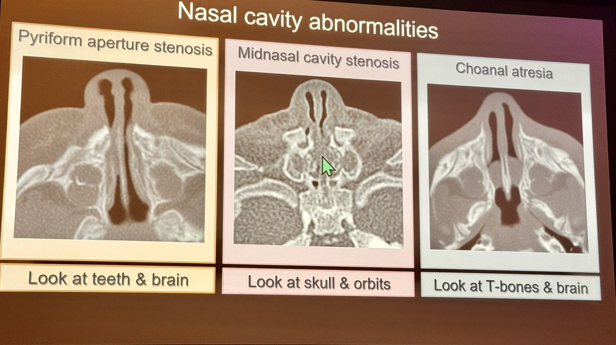 Our brilliant division chair & renowned teacher @callyrobs shows a series of complex craniofacial syndromes @The_ASPNR - pearls on every slide!!