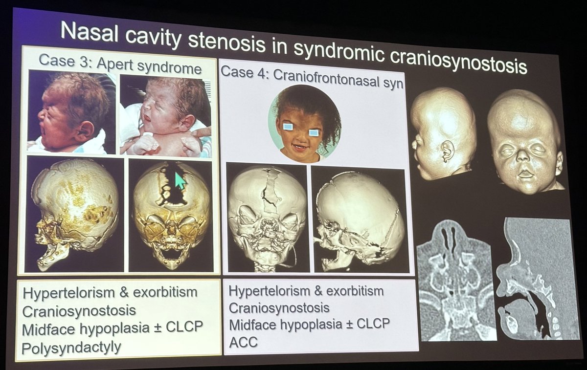 Always learning from the expert @callyrobs from @boschildrensrad! Craniofacial Anomalies at #ASPNR24. @The_ASPNR #PediNeuroRad #NeuroRad #radiology