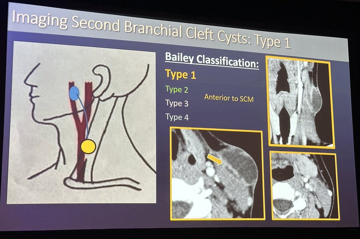 Fantastic presentation by Dr. Jennifer Vaughn from @PhxChildrens on Brachial Apparatus Anomalies at #ASPNR24! A confusing topic so well-illustrated and taught! @The_ASPNR #PediNeuroRad #NeuroRad