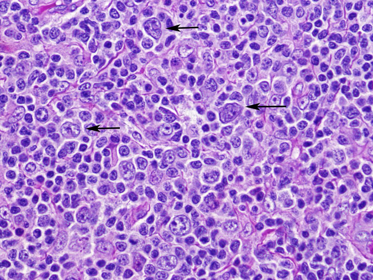 nihardesai7's tweet photo. 30/♂️/ with right cervical lymphadenopathy!!

Excision biopsy 👇🏼 Time for some 🍿

Diagnosis?
Management?

#MedTwitter https://t.co/Ozv7l7WDNO