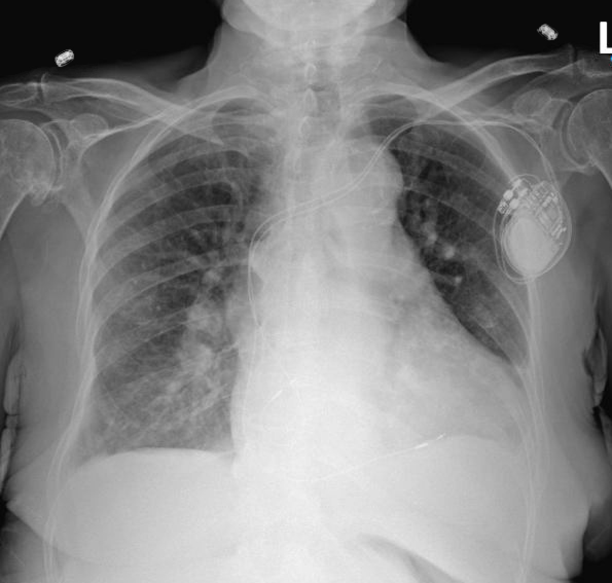 4-chamber cardiac resynchronization with 2 leads - Bachmann's bundle and left bundle branch pacing
#EPeeps