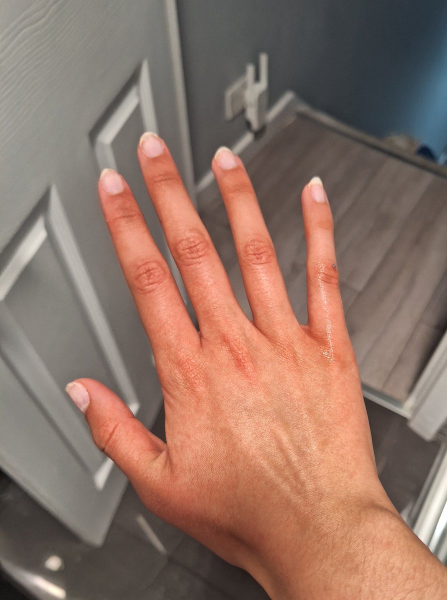 look at my hand after going out w my dog in the freezing cold