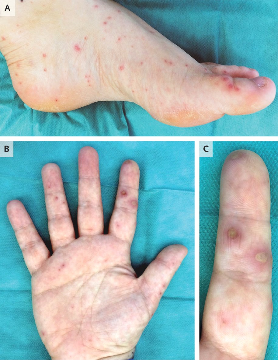 ♀️36 años #mordida por una #rata: fiebre, artralgias, mialgias, cefalea y erupción maculopapular en pies (A) y manos (B), con formación de pústulas (C); tobillo dcho., rodilla izd. y  muñeca izd. hinchados y sensibles a la palpación. 
1/3

DOI: 10.1056/NEJMicm1905921
#infecciosas