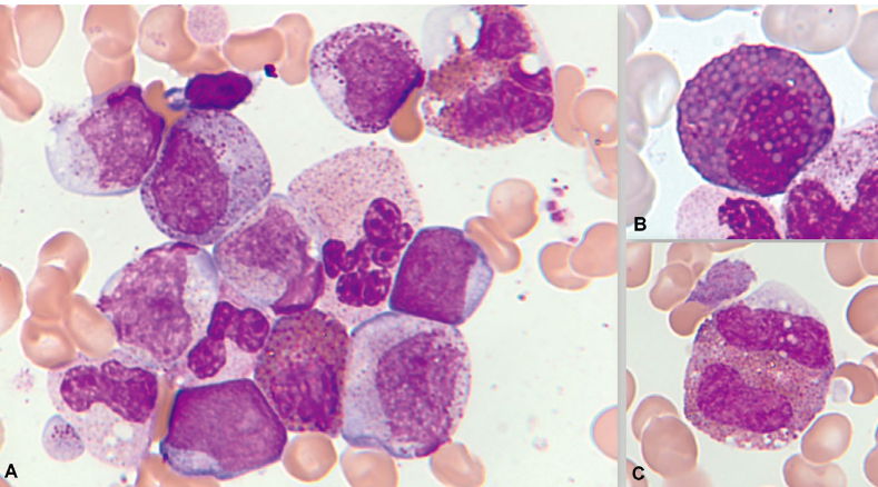 Hematological Neoplasms with Eosinophilia mdpi.com/2636748 #mdpicancers via @Cancers_MDPI