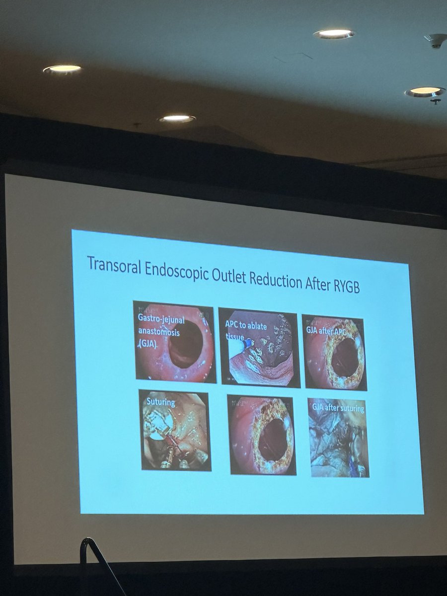 The incredible <a href="/PopovVioleta/">Violeta Popov, MD PhD</a> dropping knowledge 💎💎  on “Post Bariatric Surgery Complications” 

<a href="/AmCollegeGastro/">ACG</a> #2ndYrFellowsCourse