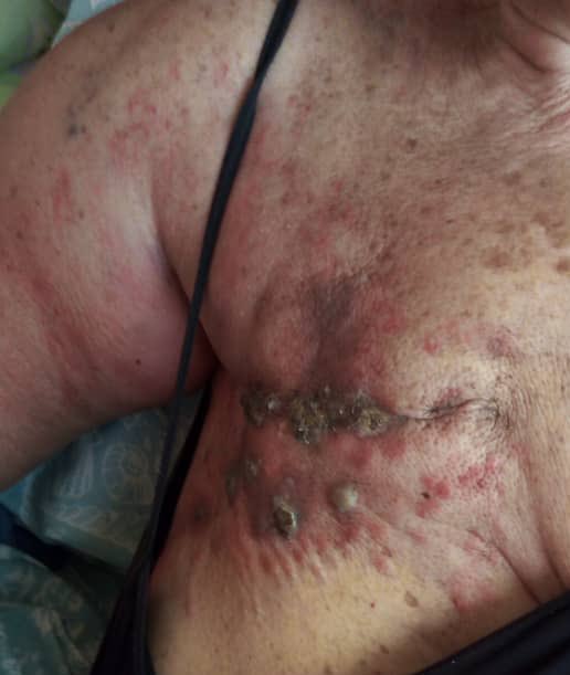 rcamachovzla's tweet photo. https://t.co/FpUJltYjiq

Sigo con la campaña para ayudar a mi mamá con el tratamiento del cáncer. En estos momentos está recibiendo quimioterapia y derrame pleural se ha complicado. Está con un concentrador de oxígeno ya que la saturación la tenía en 70. En los próximos días se le estará realizando el drenaje del líquido ya que los pulmones se encuentran comprometidos.
Luego seguirá con la quimio y esperando que vaya recuperándose poco a poco. Agradezco a todas las personas que nos han apoyado durante estos largos años en esta enfermedad que atraviesa mi mamá y mi familia.

La campaña es para costear estos tratamientos y seguir con el proceso en el que estamos en estos momentos. Sé lo difícil de la situación actual, la vivo, pero aunque sea compartiendo y con sus oraciones ayudan.

Aparte del Gofundme también tenemos PayPal y Zelle: racm1711@gmail.com

Nuevamente gracias y disculpen el fastidio, la mendicidad por redes o si incomodo de alguna forma, no tengo otra solución por el momento. Gracias.