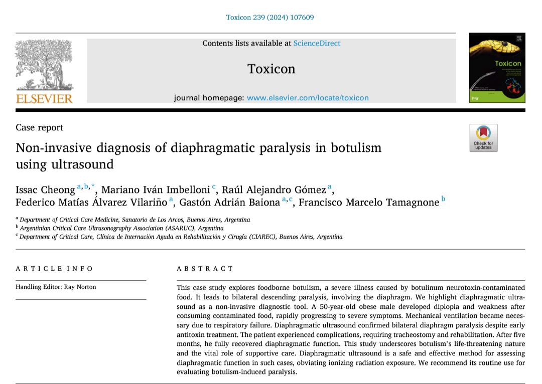 Non-invasive diagnosis of diaphragmatic paralysis in botulism using ultrasound Toxicon DOI: doi.org/10.1016/j.toxi… 50 days' free access Sharelink: authors.elsevier.com/a/1iQIh9KnftukN @panchopocus @asaruc1 #POCUS #botulism #diaphragmparalysis