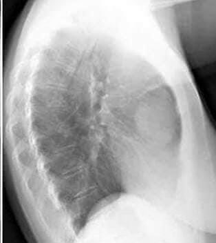 hemo_shk's tweet photo. A 51 year old male pt
Complain from chest pain&cough.
What is Spot diagnosis?......
#MEDHM
#MedTwitter https://t.co/kOjr2e4qGf