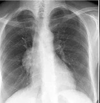 hemo_shk's tweet photo. A 51 year old male pt
Complain from chest pain&cough.
What is Spot diagnosis?......
#MEDHM
#MedTwitter https://t.co/kOjr2e4qGf