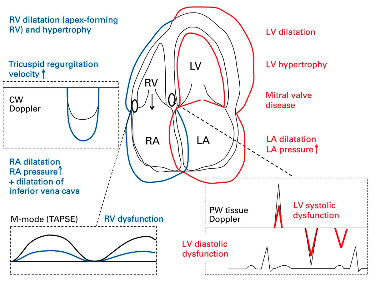 Important echocardiographic features for the assessment of patients with suspected pulmonary hypertension.
#POCUS #MedEd #FOAMed #FOAMcc
🔗 smw.ch/index.php/smw/…
Fig. description - click ‘ALT’
