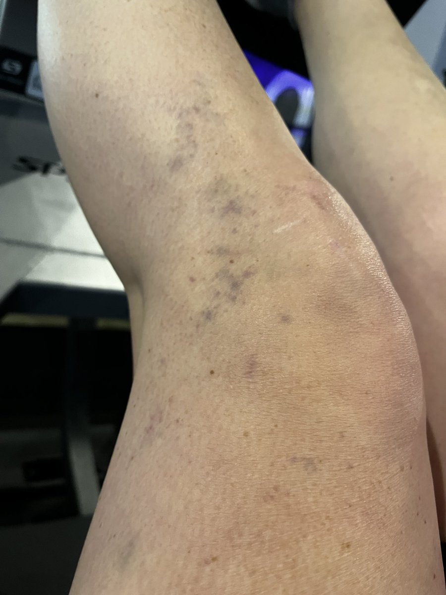 Any ideas 💡 why my leg has this blotchy bruising? Returned to rugby practice this week but no contact and no collisions or obvious MOI!! #aclrehab #11months #physio #orthopods