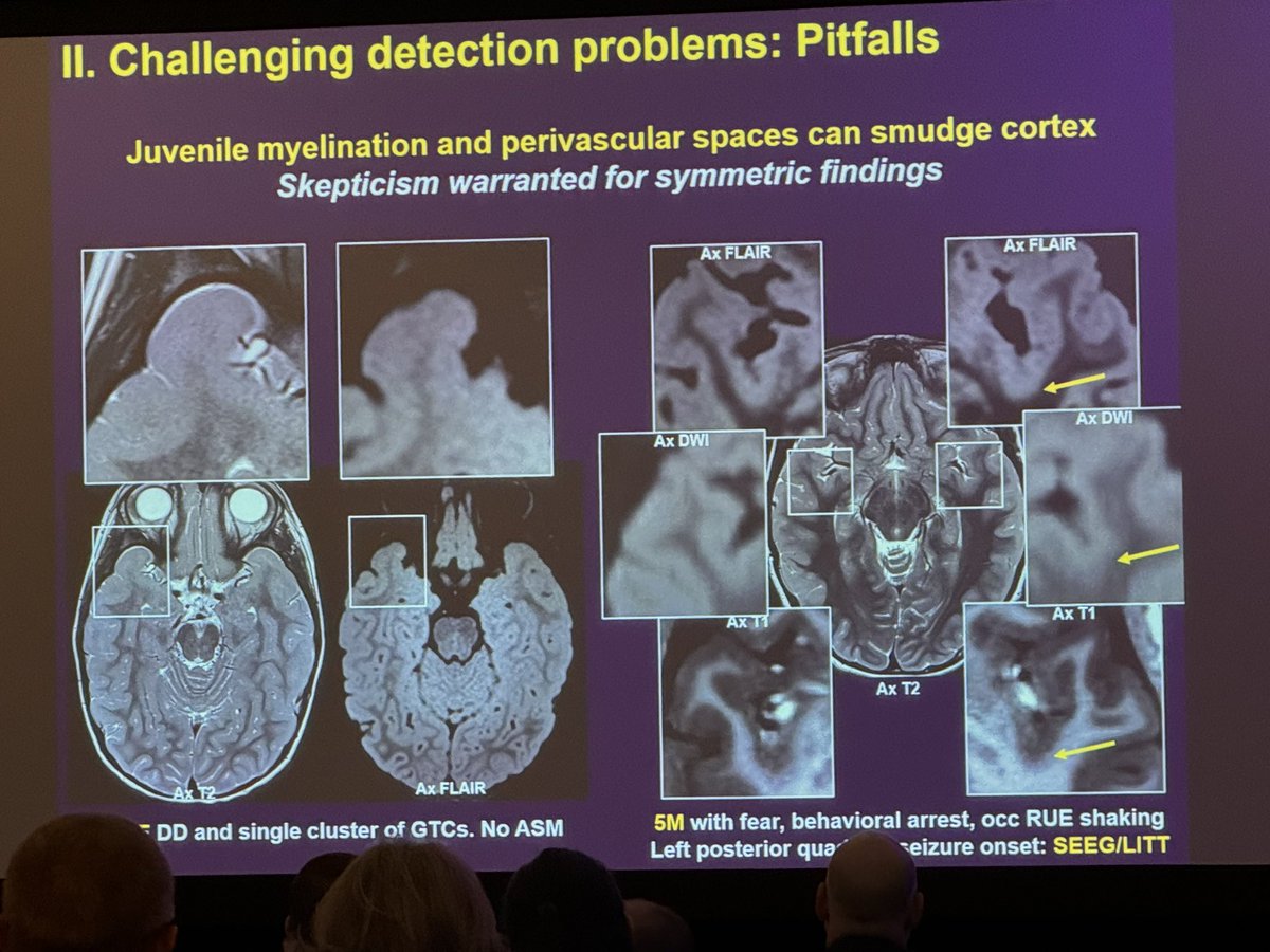 Our brilliant Edward Yang wows the audience @ASPNR with his talk on detecting focal lesions in children with #intractableepilepsy- pointing out pitfalls and pearls galore!