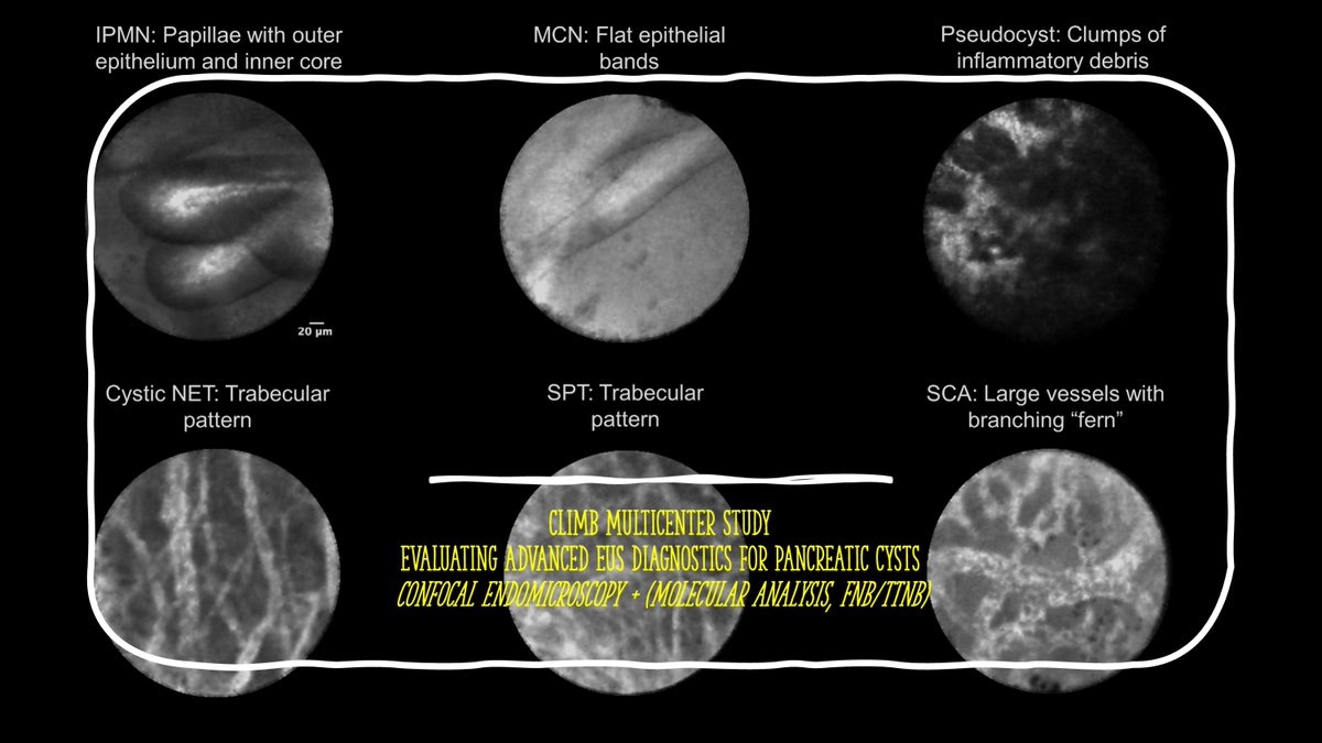 C⃣onfocal L⃣aser Endomicroscopy as an I⃣M⃣aging B⃣iomarker for the Diagnosis of Pancreatic Cysts (CLIMB) Update: Congratulation to @JessWidmer3 for enrolling the first patient from @nyulangone !!! clinicaltrials.gov/study/NCT03492…