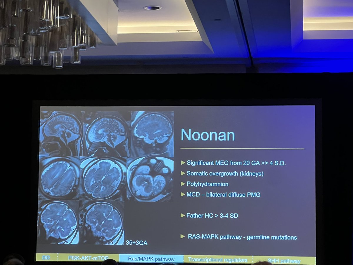 Dr. Liat Ben-Sira shows us subtle differences in fetal macrocephaly. Remember to look at fetal body for clues to overgrowth. #ASPNR24 #PediNeuroRad