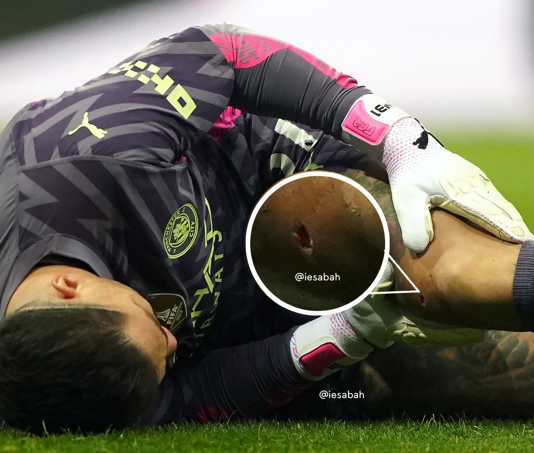 City_Xtra's tweet photo. Ederson’s injury vs Newcastle. [via @iesabah] https://t.co/GxzdHWWmiv