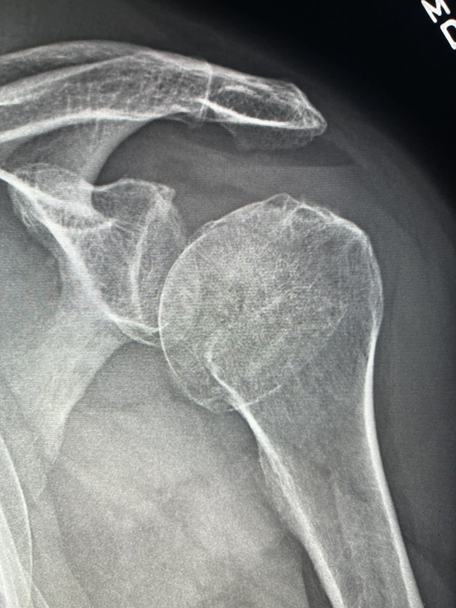 darthglader's tweet photo. Interesting #MSK case - shoulder pain after a fall in the kitchen. https://t.co/GxRo7Hd7k8