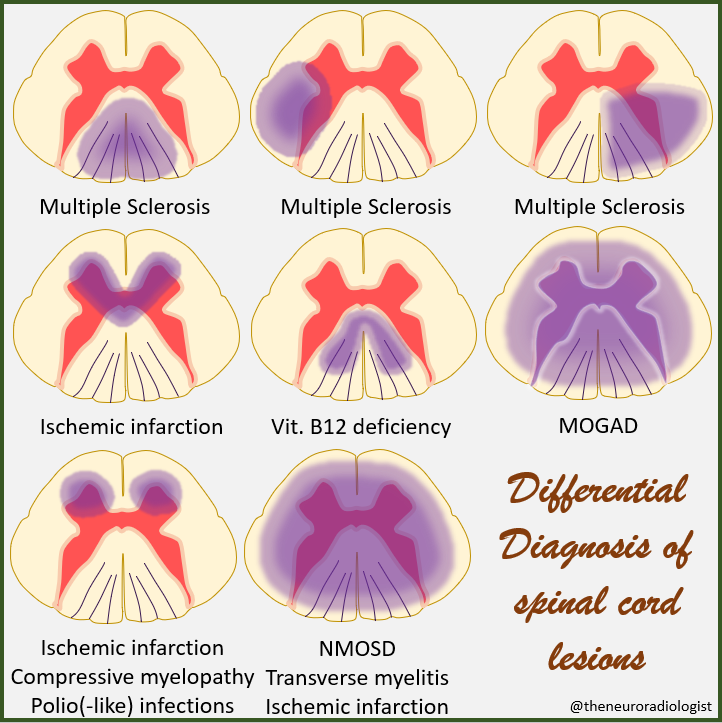 Differential Diagnosis of Spinal Cord Lesions on MRI, an on overview. #radiology #neuroradiology #Neurology  #MedEd #FOAMed #medstudent #medstudenttwitter