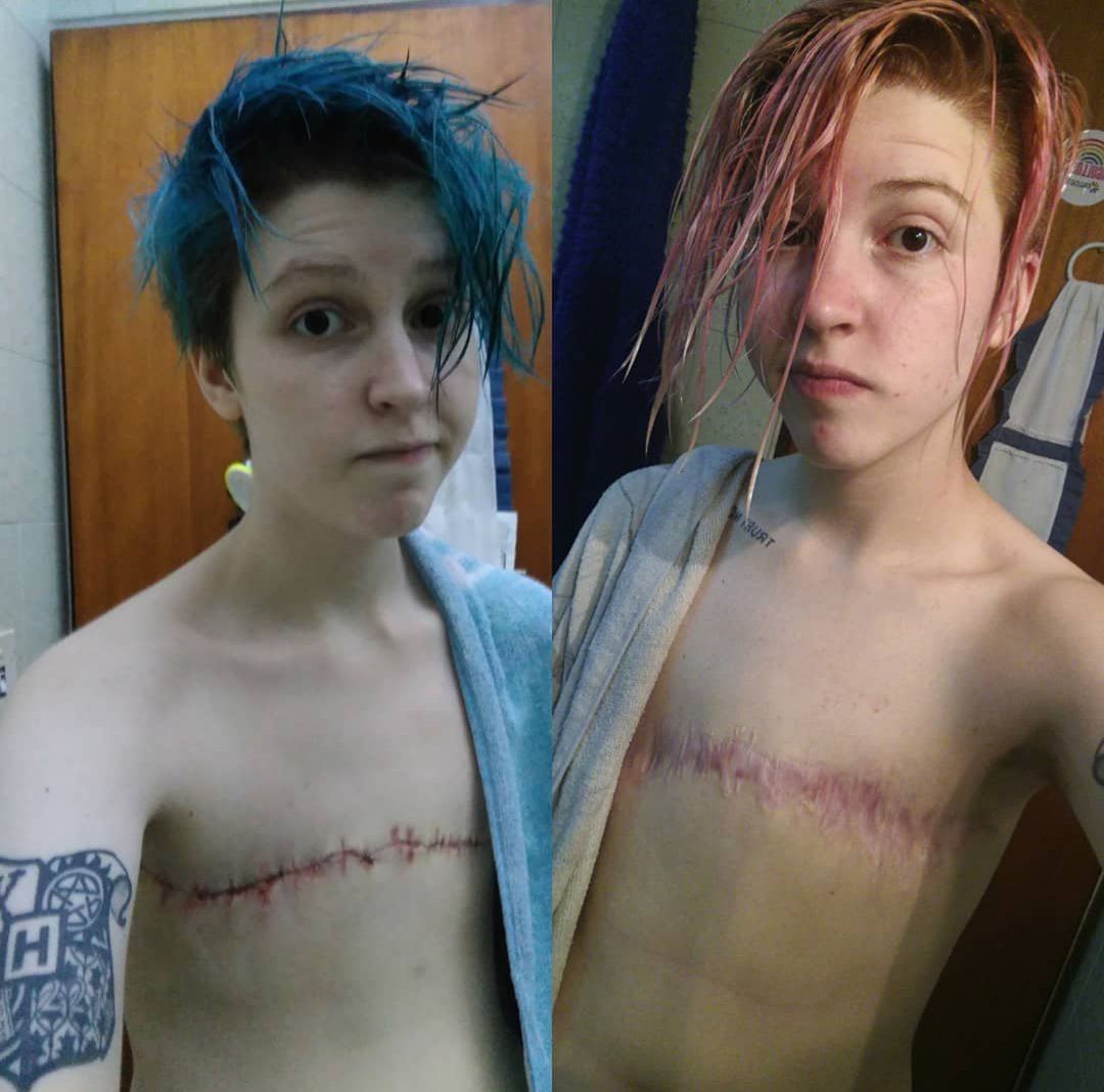 z4ckito13's tweet image. Congrats! You found me. This will be (hopefully) my only fckng tweet here.
1) No, i was not a minor when i had top surgery in 2017
2) Yes, it was top surgery, I'm not a cancer survivor
3) I'm not even from your country, can y'all just mind your business fgs???