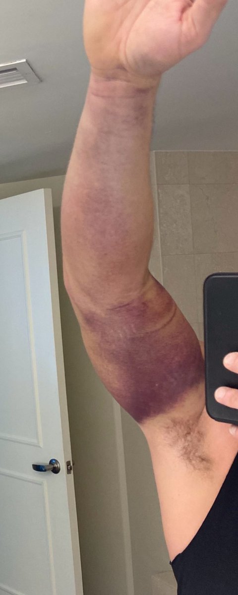 RiskTakerJM's tweet photo. @FLCUBSFAN45 Been there bud!  Not a fun recovery. https://t.co/oLADQcIGLX