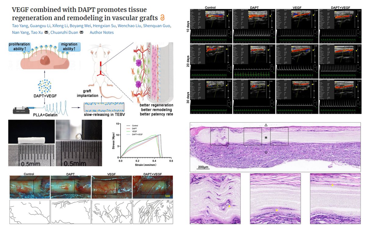 HaoYin20's tweet photo. #TissueEngineeredBloodVessel #TEVG
φ 1.3mm
L 8mm
Electrospun PLLA+Gelatin fiber φ1.6μm
Loaded VEGFA+DAPT
Implanted into rat aorta
⏫endothelialization+#SmoothMuscleCell invasion+advent vascularity/M2 Mφ
No thrombosis
90% patency by 30d
Regen Biomat 2023
https://t.co/sb5NPyIuya https://t.co/Ou1NjvoaeS