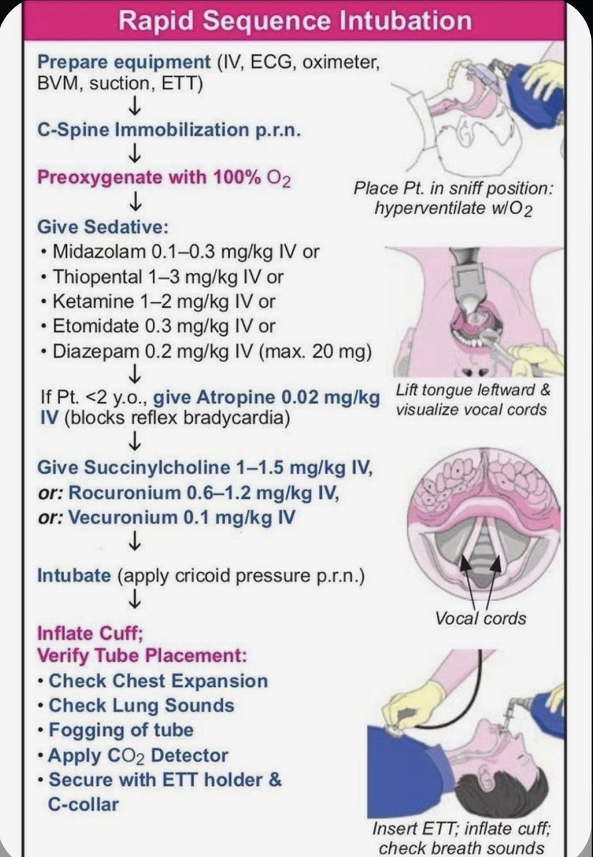 OGdukeneurosurg's tweet image. What’s a rapid sequence intubation ?