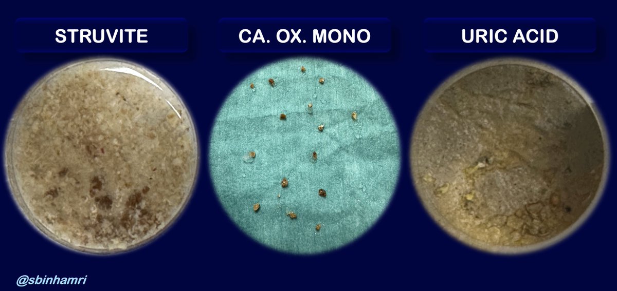 🔁 #FANS / #DISS Everywhere ✨Thoughts: 🔴Endoscopic Stone Free 🔴No Early Post Op. Imaging anymore 🔴Just remove the stent @PETRAurogroup @PEARLSendouro