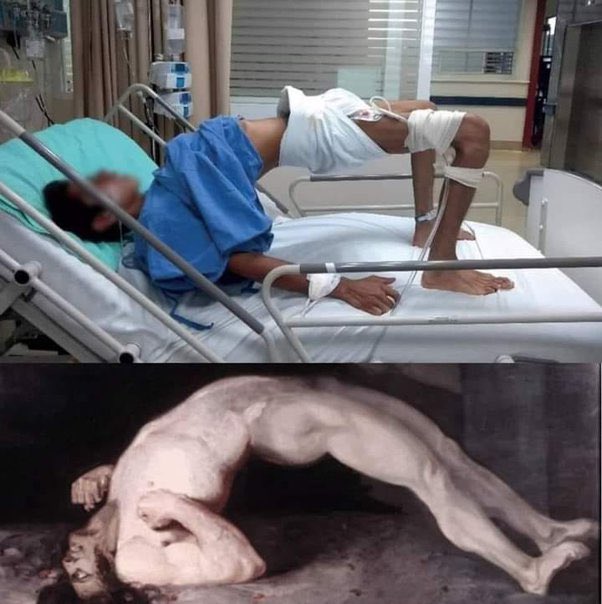 ‘opisthotonus’ is seen in which bacterial infection?

#Usmle #DrSam👩🏼‍⚕️🩺 #medtwitter #match2024 #match2023 #ecfmg #ecfmgcertificate