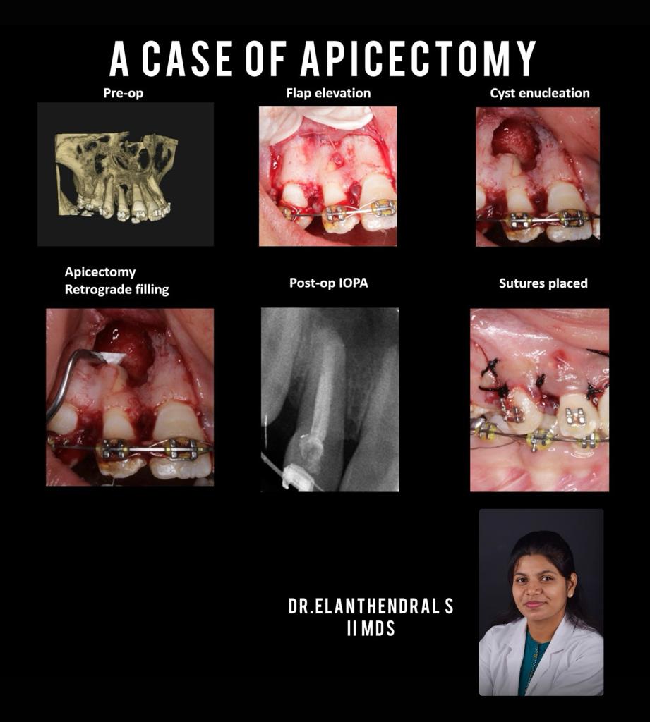 Case by our residents 💯

#pediatricdentistry #pediatric_dentistry #pediatricdentist #caseoftheweek
@DentalSaveetha