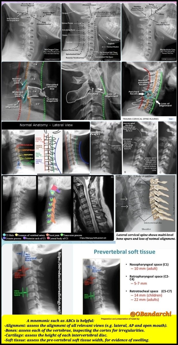 OBandarchi's tweet photo. 🟥Collections of Lat cervical spine radiographs,both normal &amp; pathologic. 

You'll see McGregor, Wackenheim &amp; Chamberlain Lines which are helpful to identify presence of basilar invagination.

I almost forgot to say "Double cortical lines" results from obliquity in lateral film. https://t.co/jNVyp4btKf