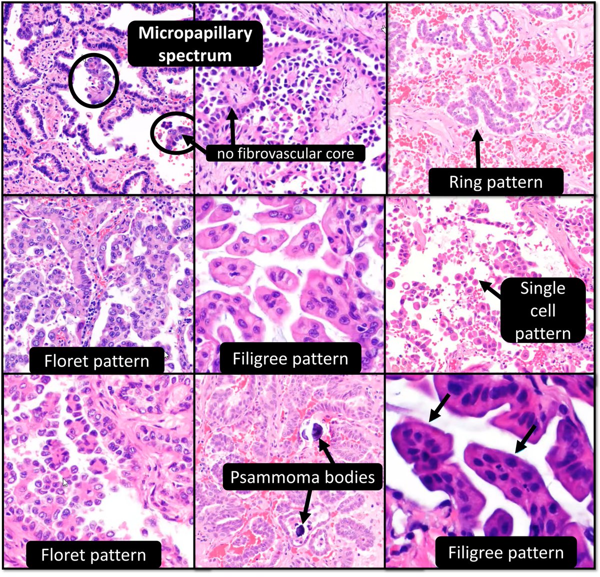 DrCycloPath's tweet photo. Micropapillary simply (and poorly) describes projections without fibrovascular cores. There are several micropapillary patterns of lung adenocarcinoma↘️; all have a poor prognosis.
#pulmpath #pathtwitter #pathresidents
@YasmeenButtMD 📽️Pathcast https://t.co/jNIVOTOL59
✅D https://t.co/j0KofoWrup