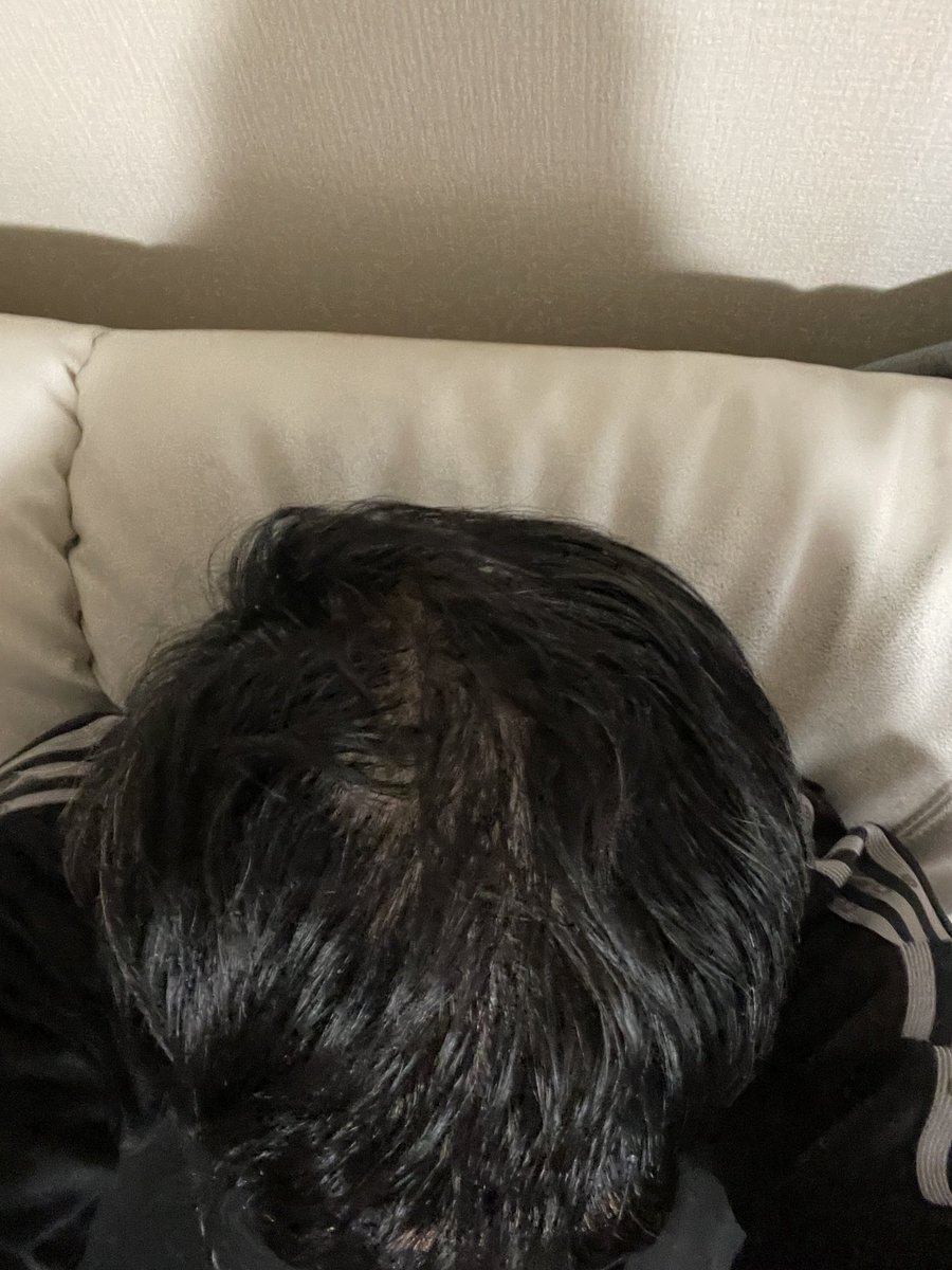 RYUJINTAO's tweet photo. 【人体実験1/29５ヶ月目】

ご無沙汰しています☺️
久々にアップします。
初期脱毛を経て、
フサフサになってきましたよ https://t.co/xvR24zfIG5