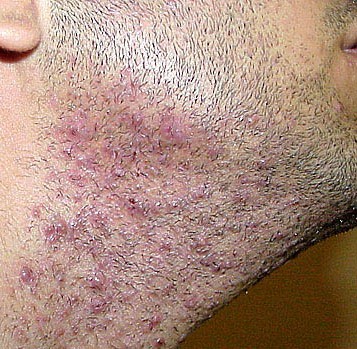 Do you get these bumps regularly? Pseudofolliculitis barbae aka #RazorBumps or shaving bumps are extremely common. 

It is associated with improper shaving technique and is more common in blade razor users vs electric razor 1/4