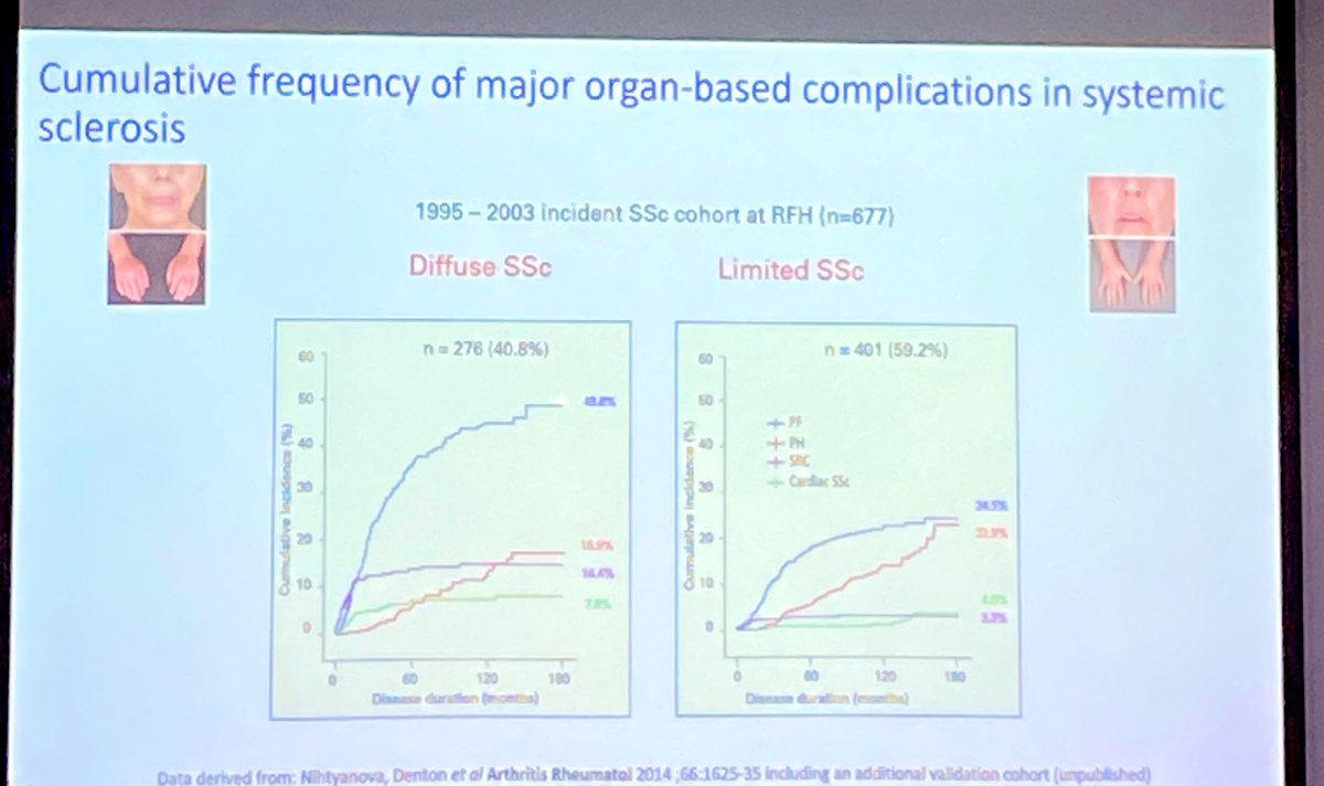 Vasco C Romao (@romaovc) on Twitter photo Early Saturday start with Prof Christopher Denton on comprehensive management of #CTD_ILD, a major involvement and complication in rare and complex CTDs. Multidisciplinary approach is key, with the patient at the centre. Combined workshop with pulmonology later on! <a href="/ern_reconnet/">ERN ReCONNET 🇪🇺</a> Early Saturday start with Prof Christopher Denton on comprehensive management of #CTD_ILD, a major involvement and complication in rare and complex CTDs. Multidisciplinary approach is key, with the patient at the centre. Combined workshop with pulmonology later on! <a href="/ern_reconnet/">ERN ReCONNET 🇪🇺</a>