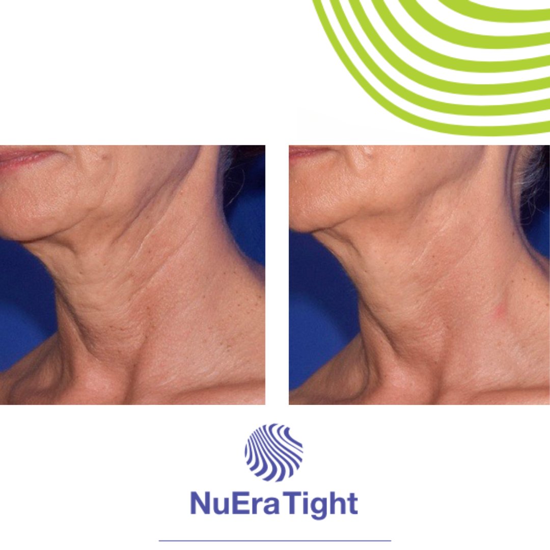 Smooth, tighten and burn fat! No pain, No Downtime! Book a complimentary 15 minute consultation for more information #nuera #nueratight #tightskin #celebrity #beauty #cellulite