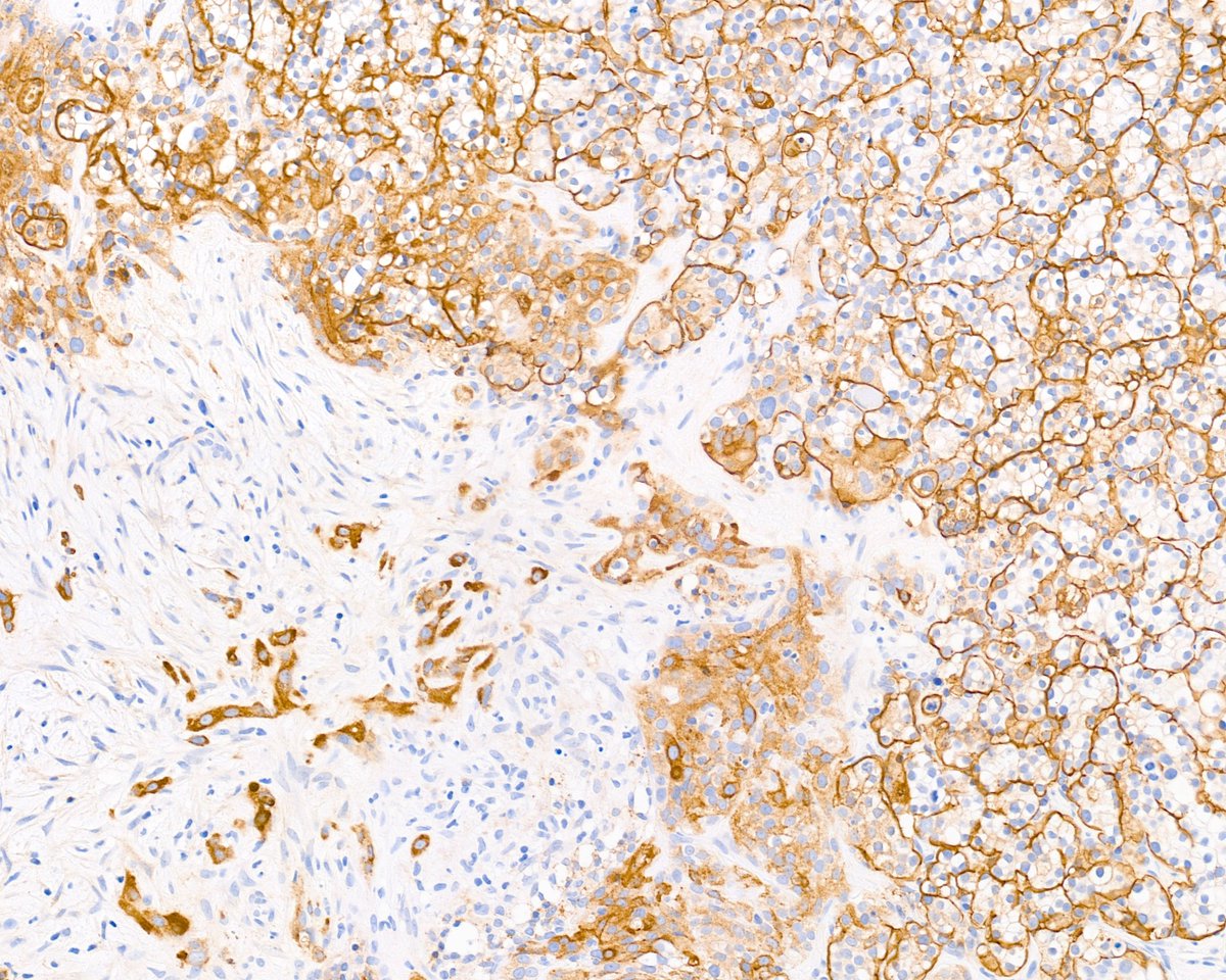 Bad bad bad becomes worse worse worse: metastatic clear cell renal cell carcinoma with sarcomatoid dedifferentiation
