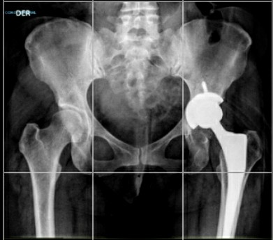 FELIPEDELGADOL8's tweet photo. Factors influencing inconsistent leg length discrepancy in dysplastic hip osteoarthritis...
https://t.co/hO3IXOnKQy

@MSKmedBMC
@JArthroplasty

Middle age female 
Modified MAASH technique( Anterior Capsular Approach with Global Capsular Preservation). https://t.co/HelaHYpYPE