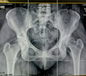 FELIPEDELGADOL8's tweet photo. Factors influencing inconsistent leg length discrepancy in dysplastic hip osteoarthritis...
https://t.co/hO3IXOnKQy

@MSKmedBMC
@JArthroplasty

Middle age female 
Modified MAASH technique( Anterior Capsular Approach with Global Capsular Preservation). https://t.co/HelaHYpYPE